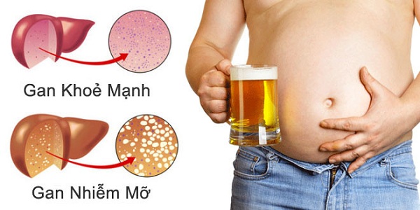 bệnh gan nhiễm mỡ cao hơn do uống nhiều rượu bia